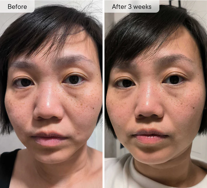 DermaQuill™ Micro-Infusion Patches