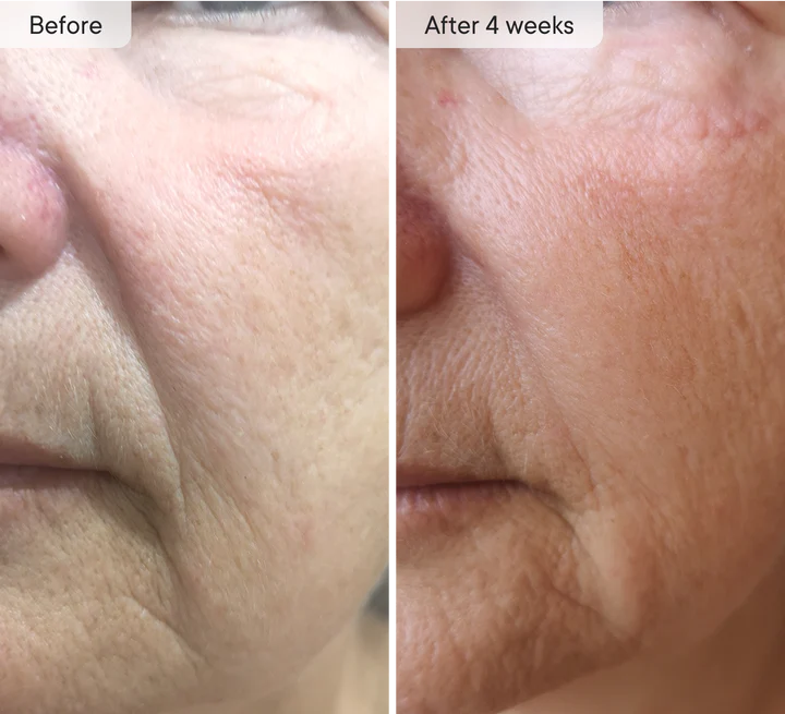 DermaQuill™ Micro-Infusion Patches