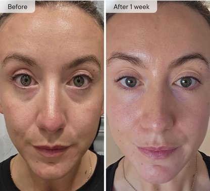 DermaQuill™ Micro-Infusion Patches